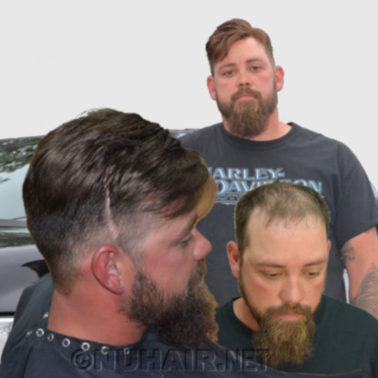 Men's Hair Restoration Replaces Hair Transplant Surgery With Nu Hair Replacement Dallas TX